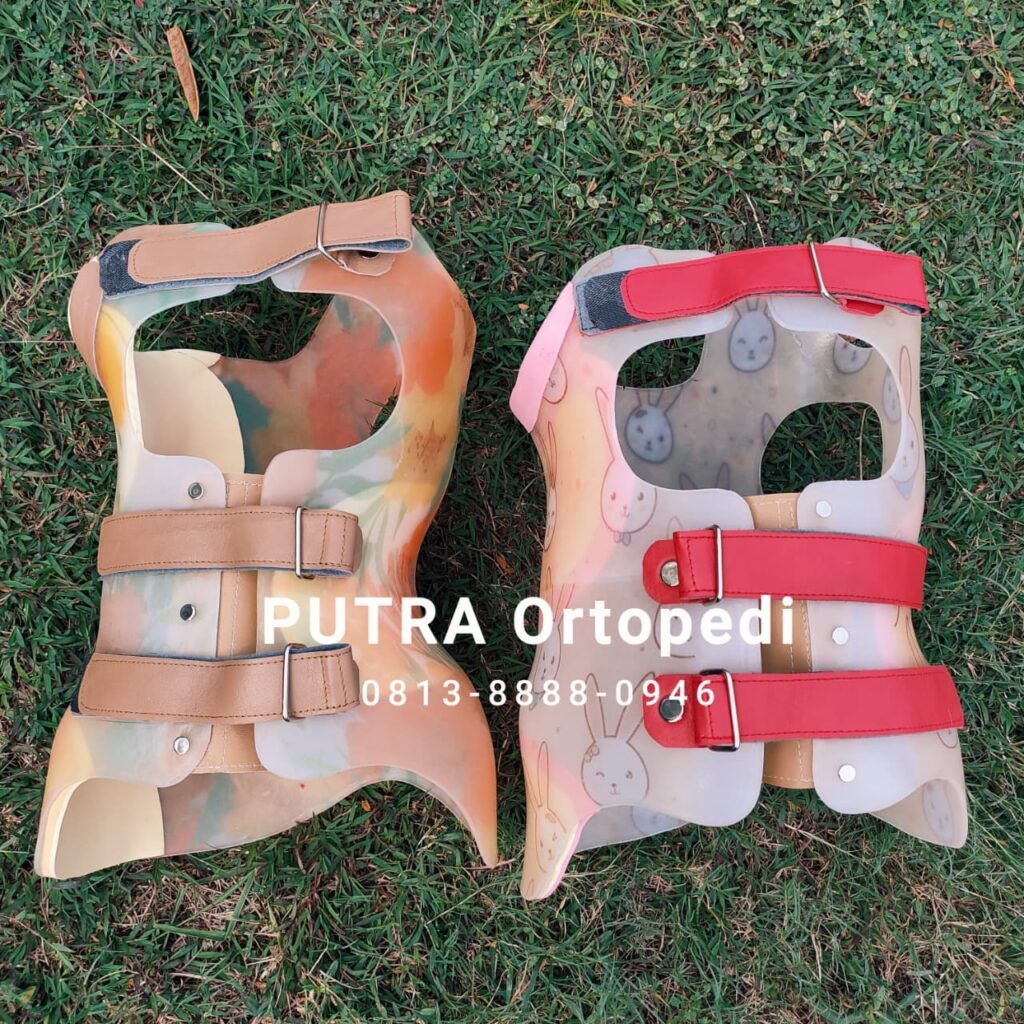 Scoliosis Brace Custom
