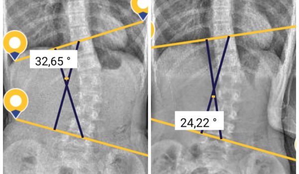 Scoliosis Brace (1)
