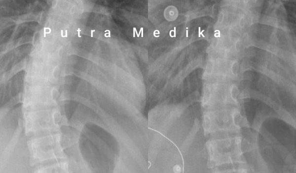 Scoliosis Brace (21)