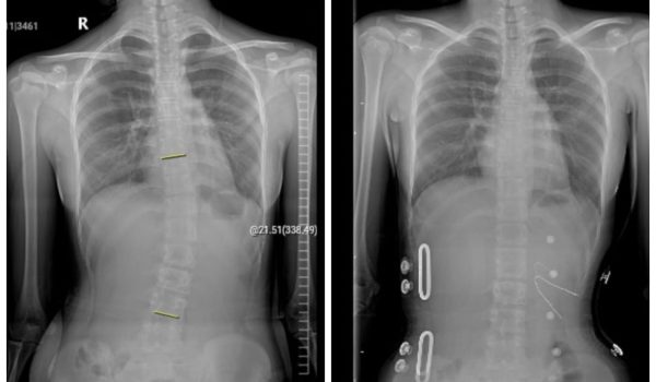Scoliosis Brace (23)
