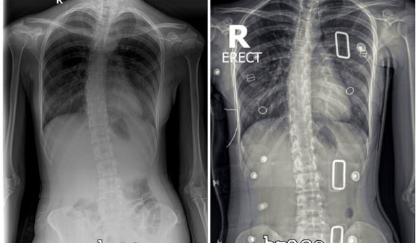 Scoliosis Brace (7)